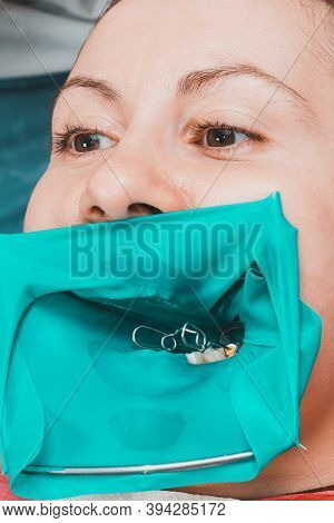 A Patient At A Dentists Appointment, A Doctor Uses A Rubber Dam To Treat Teeth, Disinfects A Tooth F