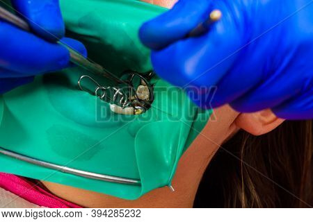 Restoration Of A Chewing Surface By Means Of Material For Filling With Photopolymer By Means Of The 