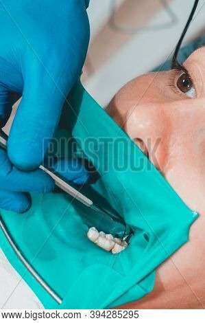 Treatment Of A Chewing Tooth, The Dentist Put A Rubber Dam, Uses Sterile Tools, Uses Modern Technolo