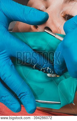 The Dentist Treats The Patients Tooth With A Rubber Dam, Drill, Mirror.