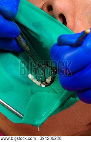 Restoration Of A Chewing Surface By Means Of Material For Filling With Photopolymer By Means Of The 