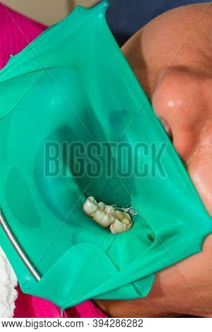 Treatment Of A Chewing Tooth, The Dentist Put A Rubber Dam, Uses Sterile Tools, Uses Modern Technolo