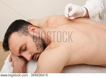 Reflexologist Doing An Acupuncture Procedure. Stress Relief With Acupuncture. Traditional Chinese Me