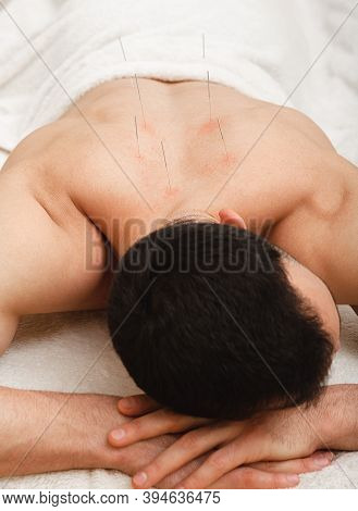 Man With Acupuncture Needles In His Back Is Receiving Treatment In A Traditional Chinese Medicine Cl