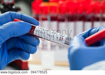 Lab Scientist Medical Technologist Labelling Blood Sample Test Tube Vacutainer, Positive Result,covi
