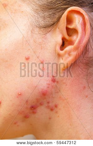 Acne Skin