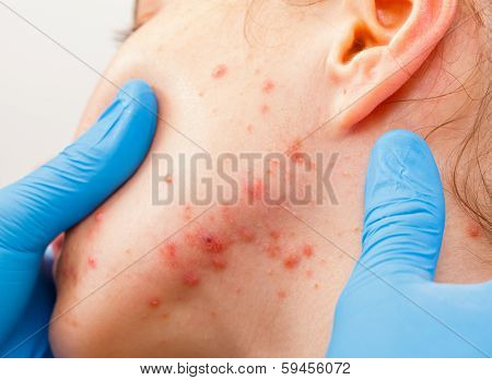 Acne Skin