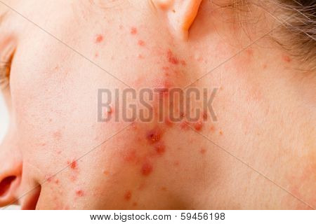 Acne Skin