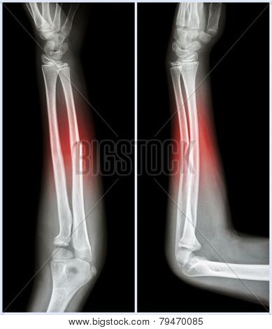 Fracture Shaft Of Ulnar Bone ( Forearm Bone )  :  ( Front And Side View )