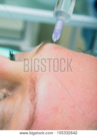 Cosmetology procedure mesoteraphy. Rejuvenation revitalization, skin nutrition, wrinkle reduction. D