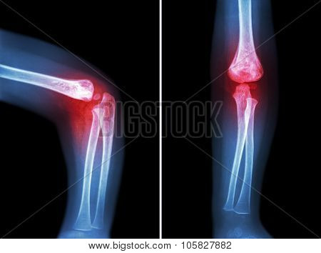 Rheumatoid Arthritis , Gouty Arthritis ( Film X-ray Child 's Elbow With Arthritis At Elbow )