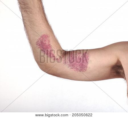 Man's hand with hematoma on white background