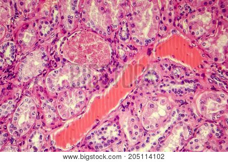 Hyaline degeneration of renal artery, light photomicrograph