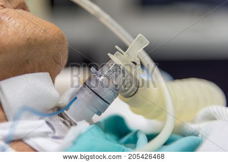 Patient Do Tracheostomy And Ventilator In Hospital