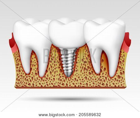 3d teeth in a cut with nerve endings and with an implant. Vector illustration