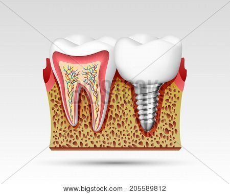 3d teeth in a cut with nerve endings and with an implant. Vector illustration