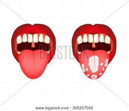Candidiasis Of The Tongue, Thrush. Inflammation Of The Tongue. Infographics. Illustration On Isolate