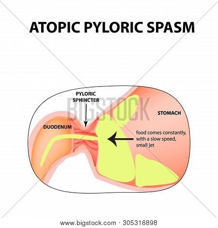Spasms Of The Pylorus. Pylorospasm. Atonic. Pyloric Sphincter Of The Stomach. Infographics. Image On