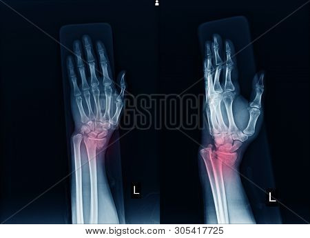 X-ray Left Wrist Joint Ap,lateral  Fracture With Displacement Distal End Left Radius.soft Tissue Swe
