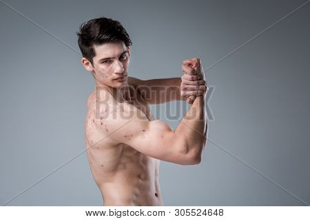 Studio Portrait Young Caucasian Man On Gray Background Posing. Theme Of Puberty, Problem Skin, Teen 