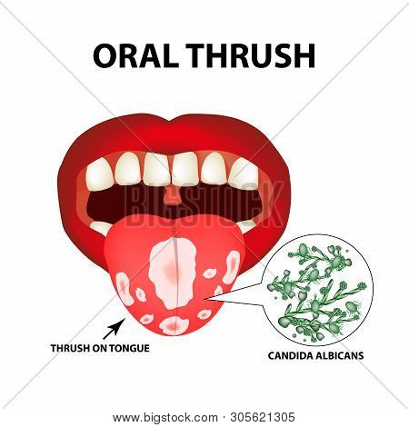 Oral Thrush. Candidiasis On The Tongue. Fungus In The Mouth. Infographics. Illustration On Isolated 