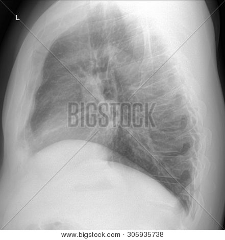 X-ray Scan Of Male Smoker Lung Without Editing. Side View With Probably Pathological Induration