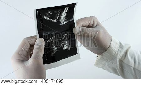 Ultrasound Of The Prostate In The Hands Of The Doctor, The Doctor Makes An Analysis Of The Prostate,