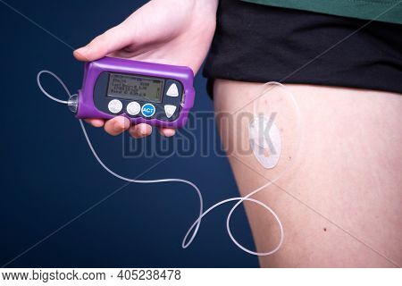 Close up view of a diabetic child with an insulin pump.Child diabetes concept.