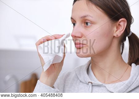 Herpes On The Nose - Pretty Young Woman Feels Discomfort Of Herpes On Her Face And Holds A Handkerch