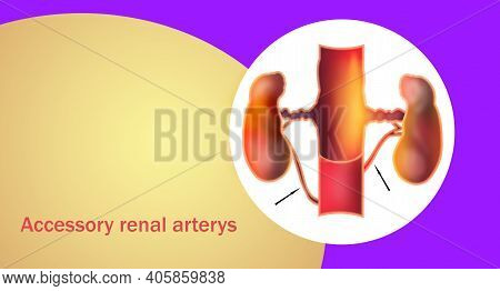 Accessory Renal Arteries Or Aras Are Embryonic Remnants Found In More Than One-third Of Patients And