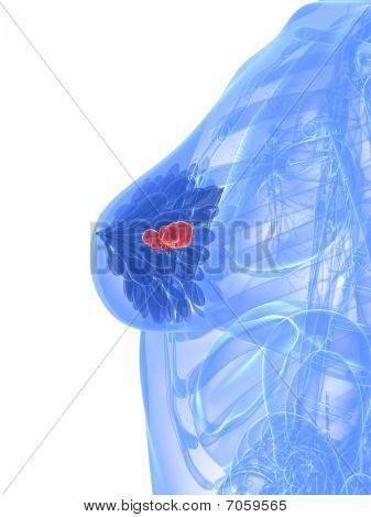 cancro al seno