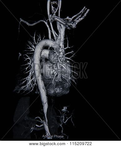 Ct Scan Angiogram (take Photo From Film X-ray)