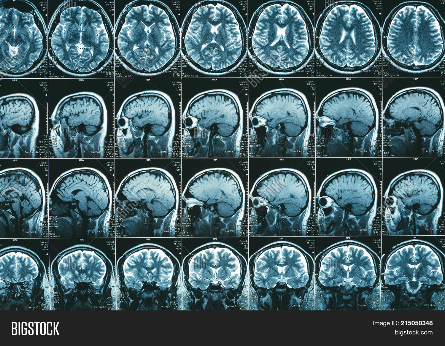MRI Brain Scan Image & Photo (Free Trial) | Bigstock