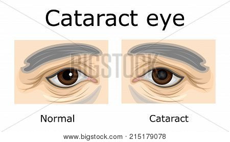 Comparison of a healthy eye and an eye with cataracts