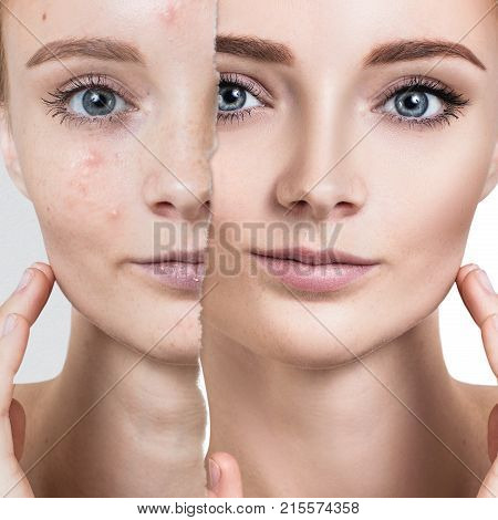 Comparison portrait of old photo with acne and healthy skin of young girl. Skincare concept.