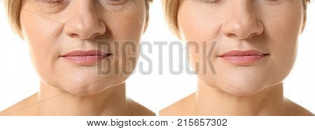 Mature woman before and after biorevitalization procedure on white background