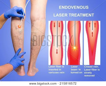 Varicose Veins. Endovenous laser treatment of female legs
