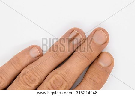 Finger Nail With Melanonychia
