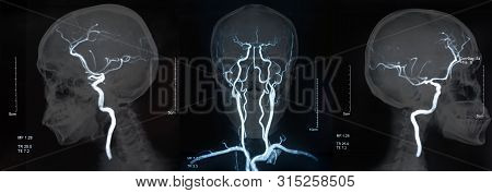 Mri Of The Blood Vessels In The Brain And Cerebrovascular Disease. Brain Stroke X-ray Image.