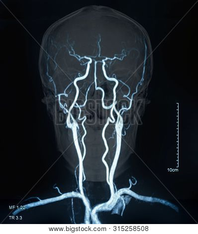 Mri Of The Blood Vessels In The Brain And Cerebrovascular Disease. Brain Stroke X-ray Image.