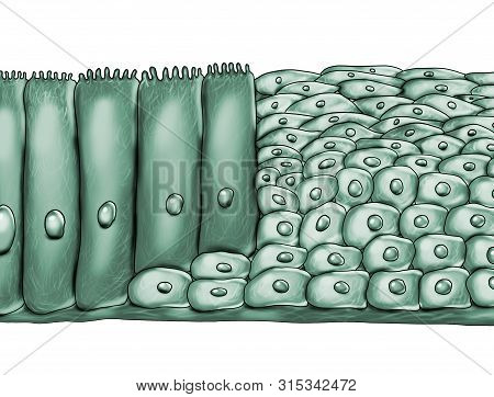 Squamous Metaplasia Of Respiratory Epithelium, A Consequence Of Cigarette Smoking , Illustration
