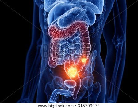 3d rendered medically accurate illustration of colon cancer