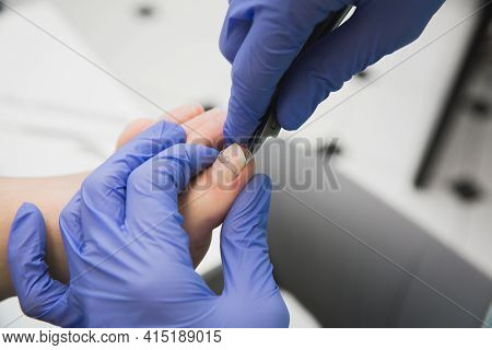 Professional Pedicure Using A Corrective Brace. A Podiatrist Doctor Treats A Patient's Ingrown Toena