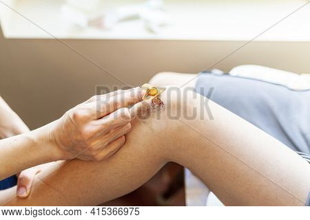 A Mother Is Removing Old Adhesive Bandage Antiseptic From The Bruised Skin Over The Knee Cap Of Her 