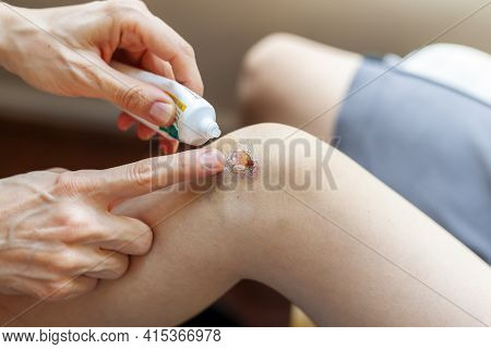 A Mother Is Applying Topical Antiseptic And Anti Inflammatory Cream Onto Bruised Skin Over The Knee 