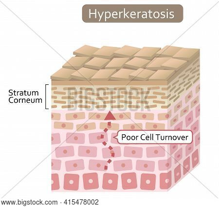 Diagram Of Skin Cell Turnover And Thickening Of The Stratum Corneum. Skin Care And Beauty Concept