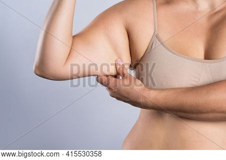 Sagging Flabby Skin On A Woman's Arm