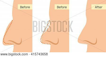 Rhinoplasty Nose Plastic Surgery Icon. Vector Rhinoplasty Beauty Face Icon Surgery