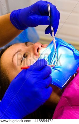 Treatment Of The Upper Sixth Left Tooth, Sterile Treatment With Roofing Felt.