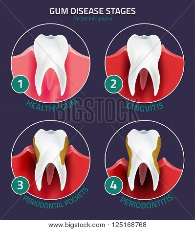 Teeth infographic. Gum disease stages. Editable vector illustration in modern style. Medical concept in red, green and white colors on a darl violet background. Keep your teeth healthy